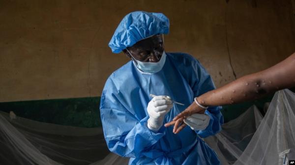 Atumisi Anaclet treats a patient with mpox on Sept. 4, 2024, in a hospital in Kamituga, in eastern Congo's South Kivu province, which is the epicenter of the world's latest outbreak of the disease. 